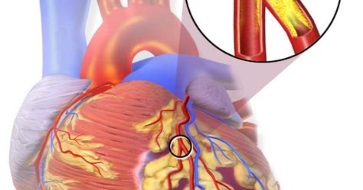 In Massive Heart Attack?