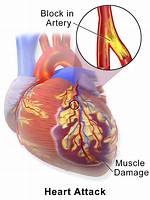 In Massive Heart Attack?