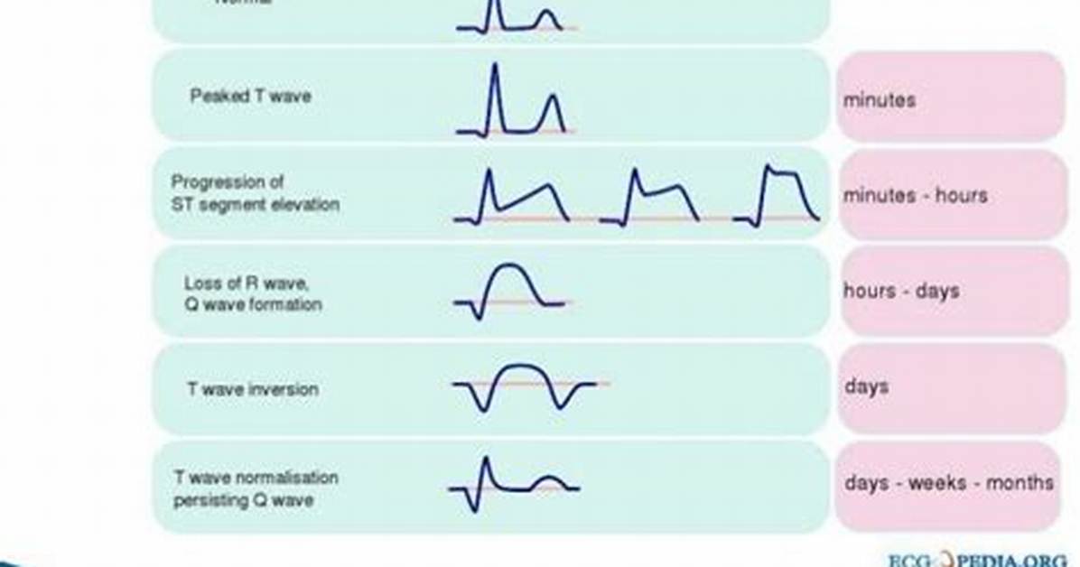 In Mi Ecg Changes?