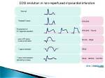 In Mi Ecg Changes?