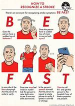 In Recognizing a Stroke?