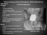 Indications for Micturating Cystourethrogram?