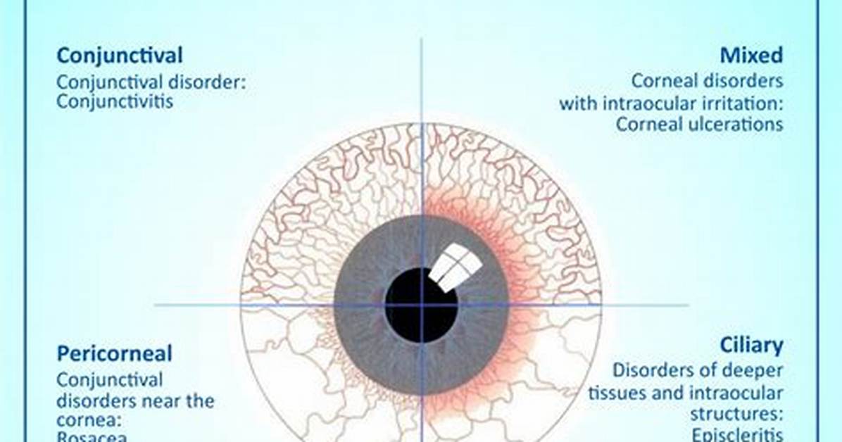 Injected Conjunctiva