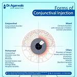 Injected Conjunctiva