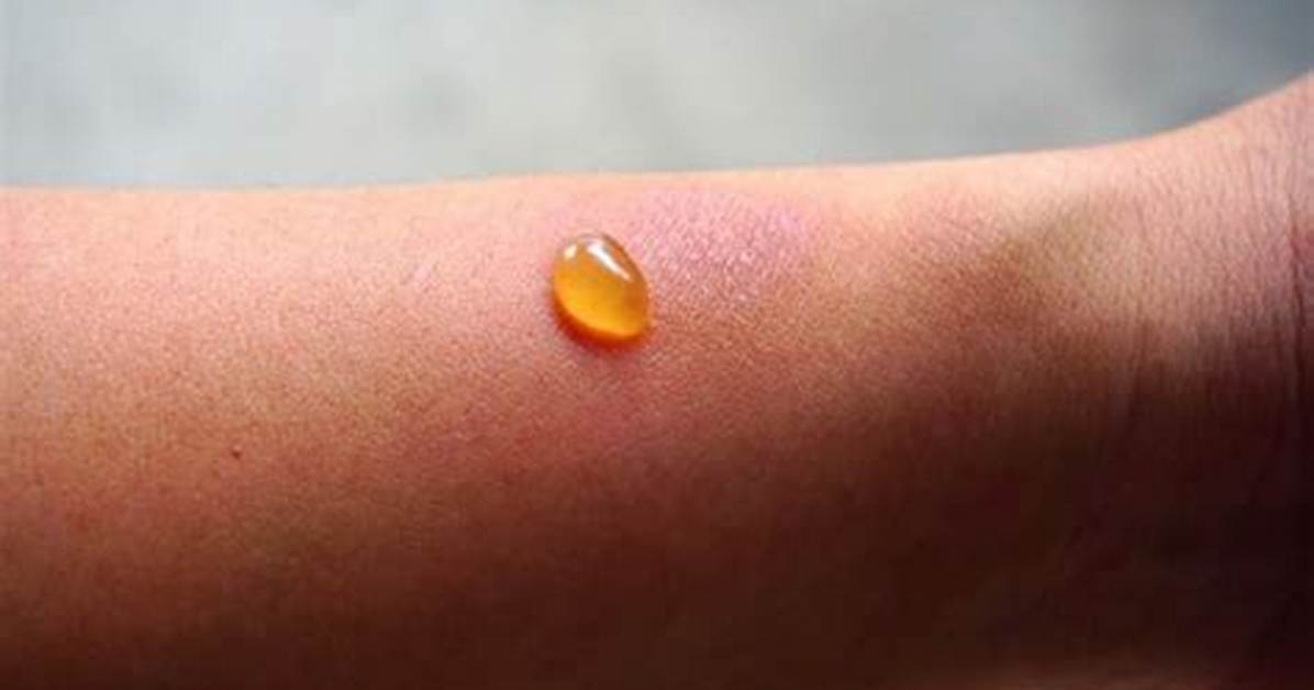 Insect Bite Weeping Clear Fluid