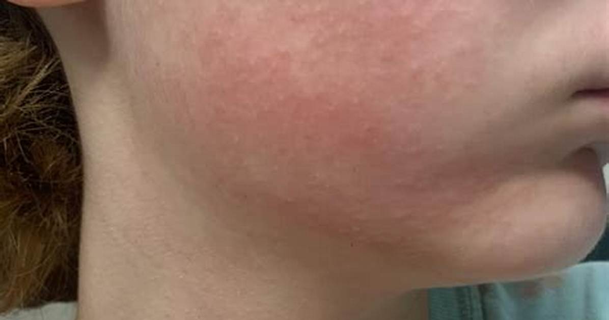 Insulation Rash