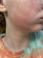 Insulation Rash