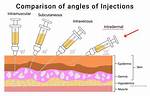 Intradermal Injection Angle