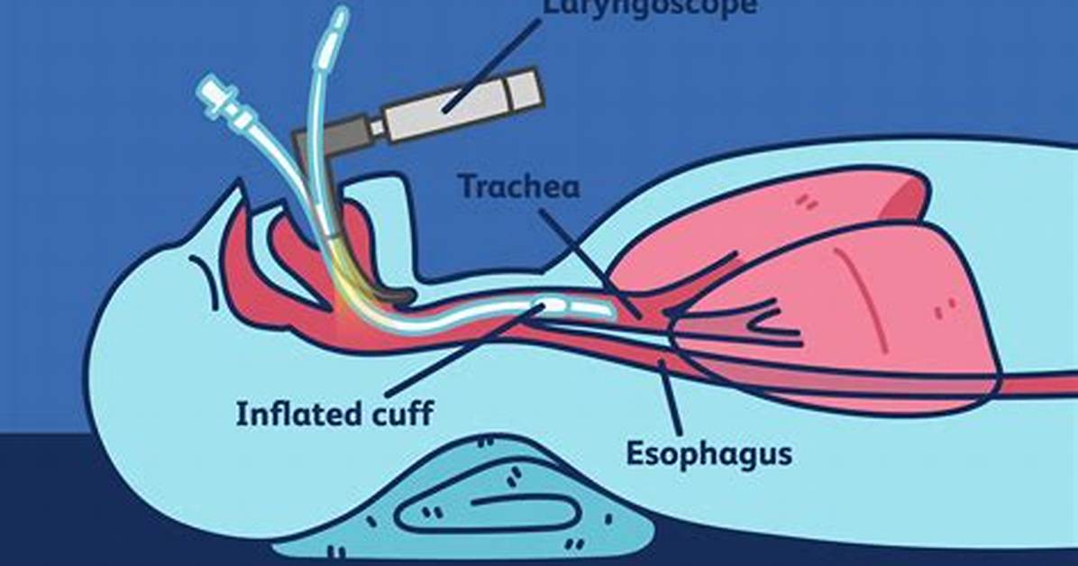 Intubation Procedure