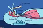 Intubation Procedure
