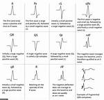 Inverted Qrs Complex