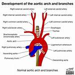 Is a Aortic Arch?