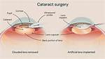 Is a Cataract Extraction?