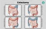 Is a Colectomy Permanent?