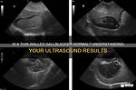 Is a Thin Walled Gallbladder Normal?