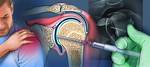 Is an Arthrogram Painful