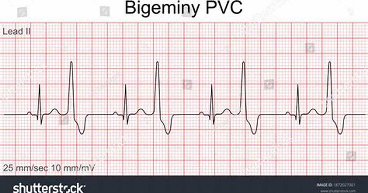 Is Bigeminy Normal
