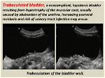 Is Bladder Trabeculation Reversible?