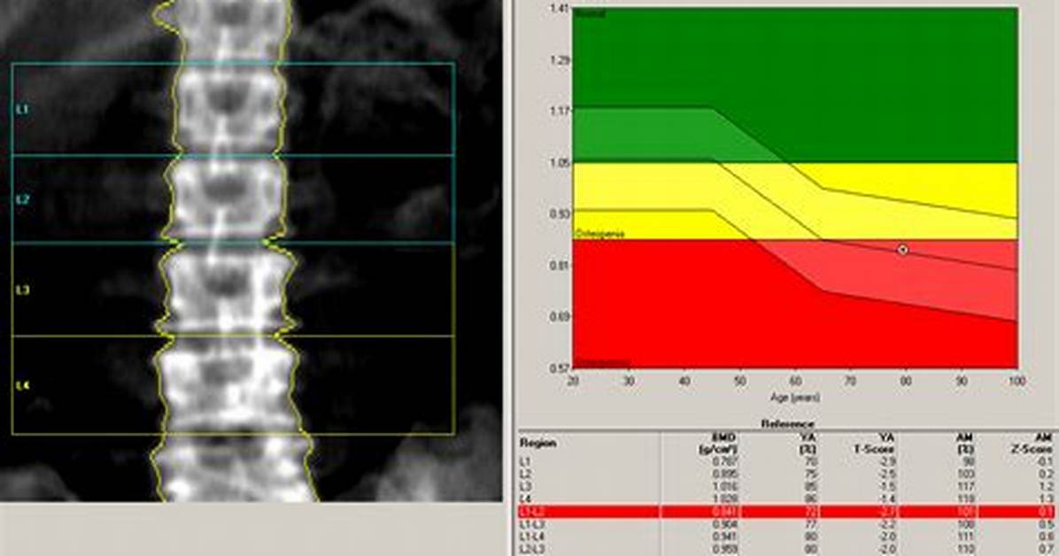 Is Bone Density Densitometry?