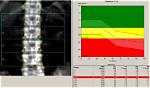 Is Bone Density Densitometry?