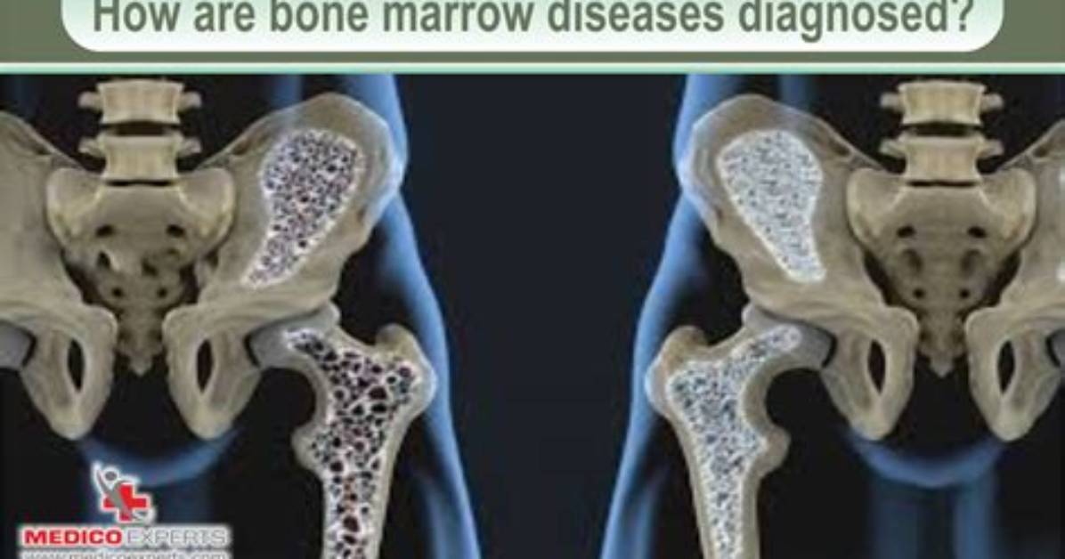 Is Bone Marrow Bad