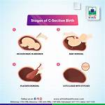Is C-Section a Delivery?