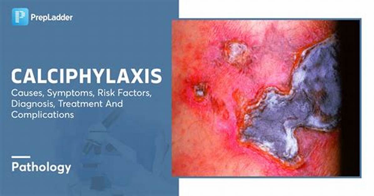 Is Calciphylaxis Curable