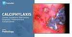 Is Calciphylaxis Curable