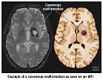 Is Cavernous Malformation Deadly?