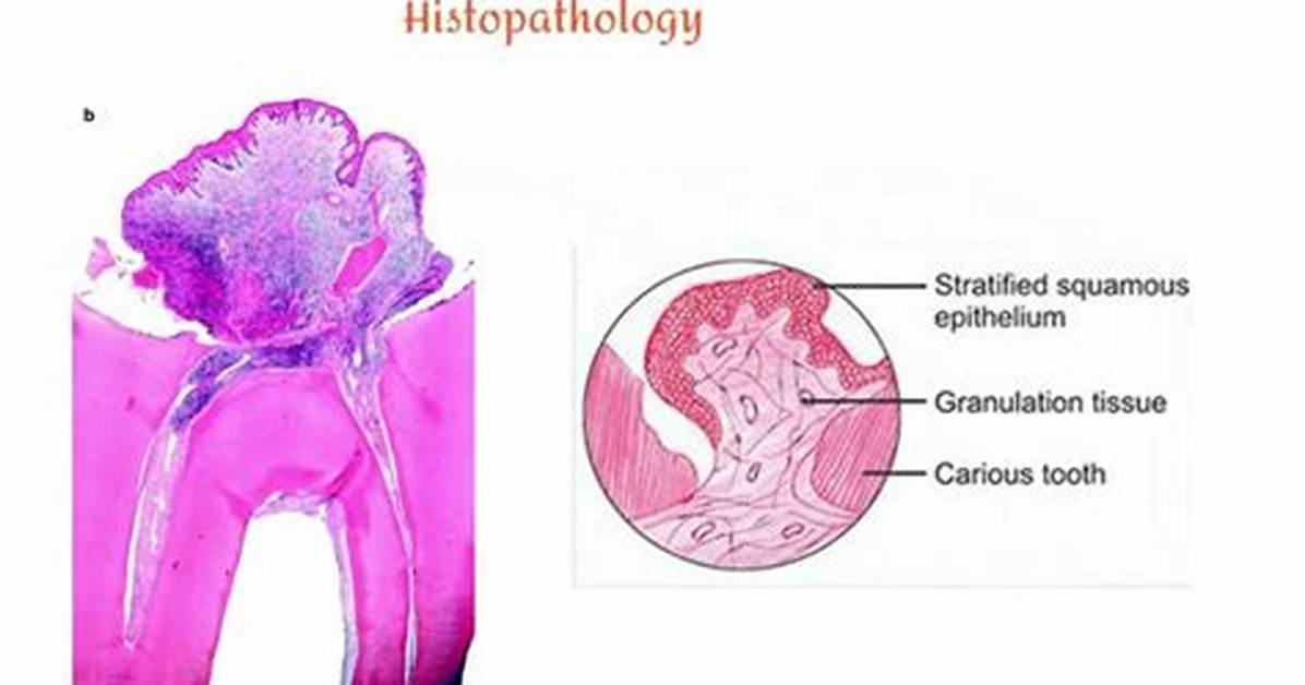 Is Chronic Hyperplastic Pulpitis?