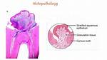 Is Chronic Hyperplastic Pulpitis?