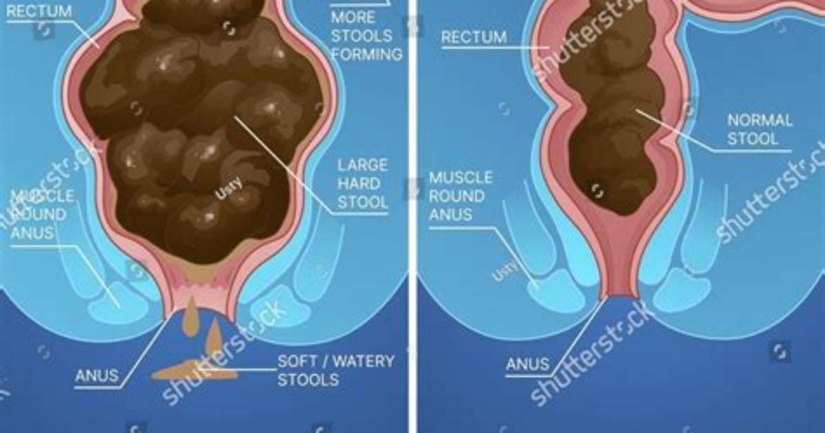 Is Constipation and Obstipation the Same?