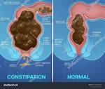 Is Constipation and Obstipation the Same?