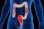 Is Corn Inflammatory