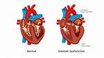 Is Diastolic Dysfunction Serious?