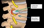 Is Disc Herniation Curable?