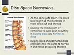 Is Disc Space Narrowing?