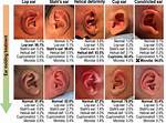 Is Ear Shape Genetic?