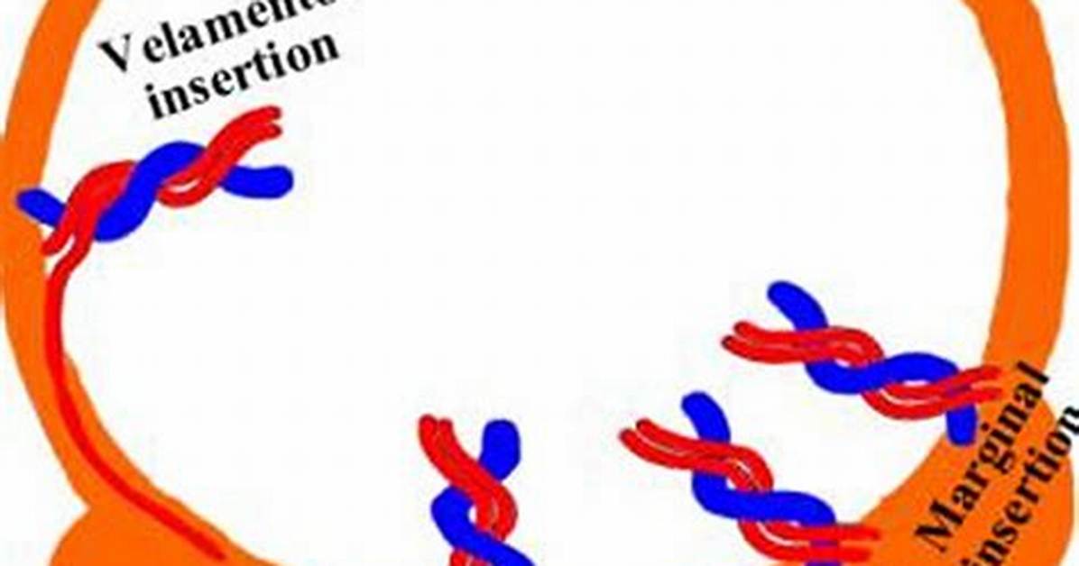 Is Eccentric Cord Insertion Normal?