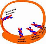 Is Eccentric Cord Insertion Normal?