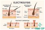 Is Electrolysis Really Permanent?