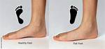 Is Flat Footed Genetic?