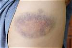 Is Getting Bruises Bad?