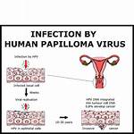 Is Hpv an Std