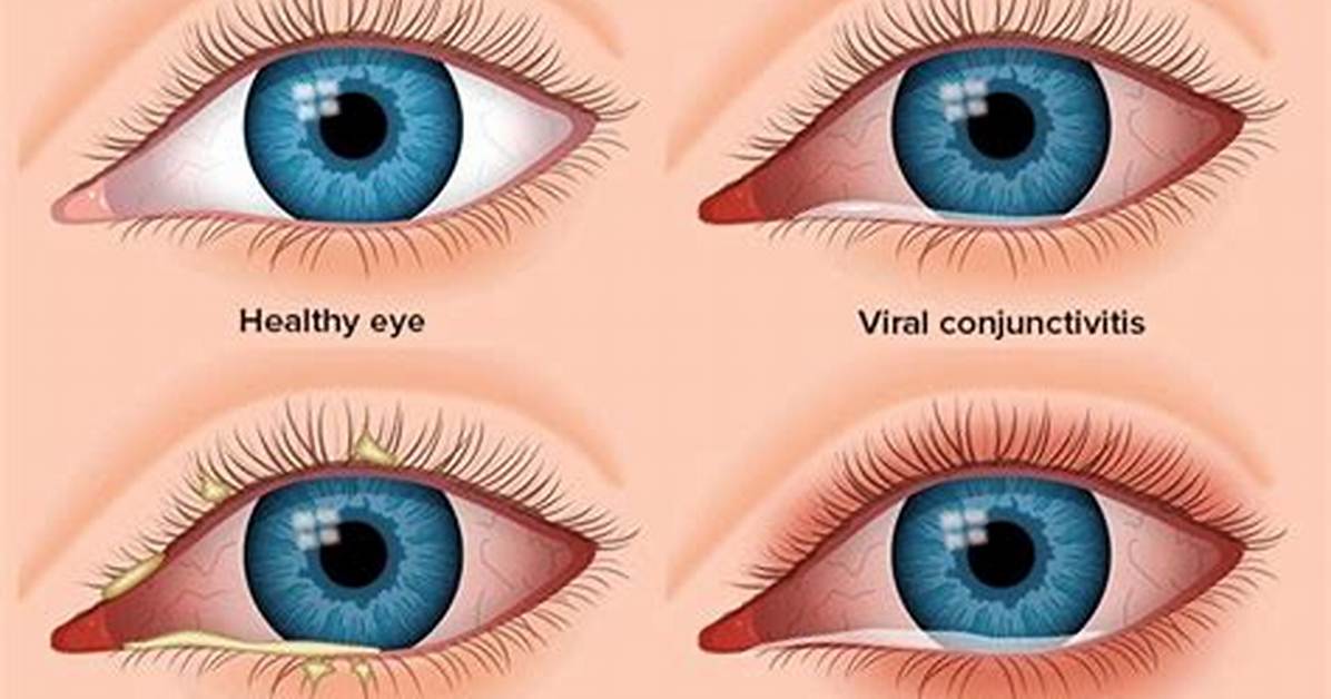 Is It Conjunctivitis or Something Else?