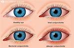 Is It Conjunctivitis or Something Else?