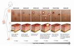 Is Lesions a Std?