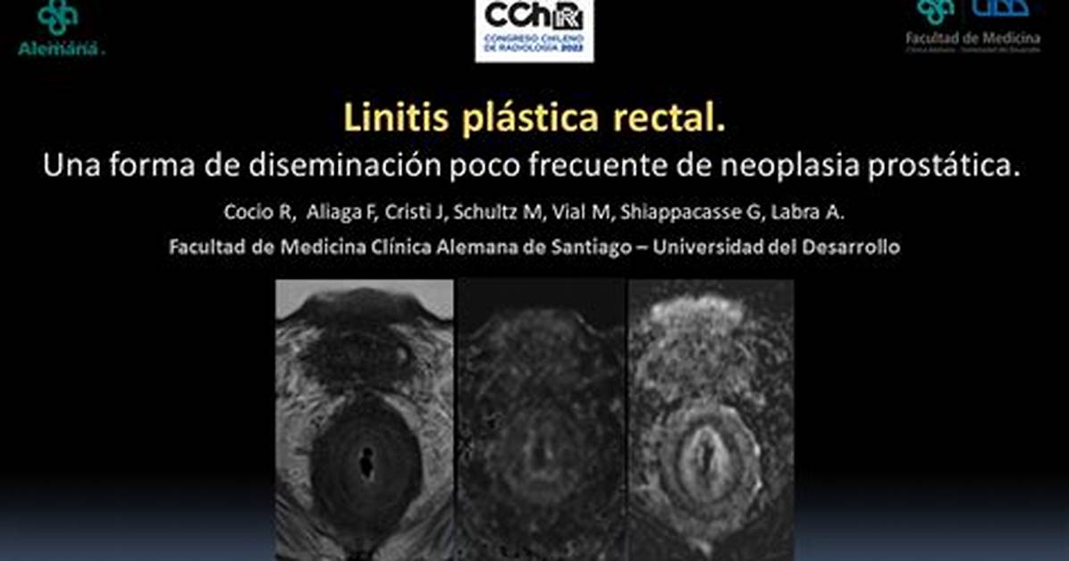 Is Linitis Plastica Curable?