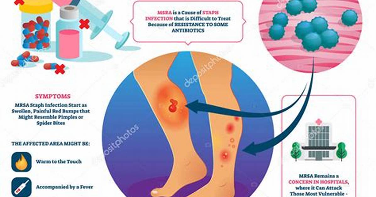 Is Mrsa Curable