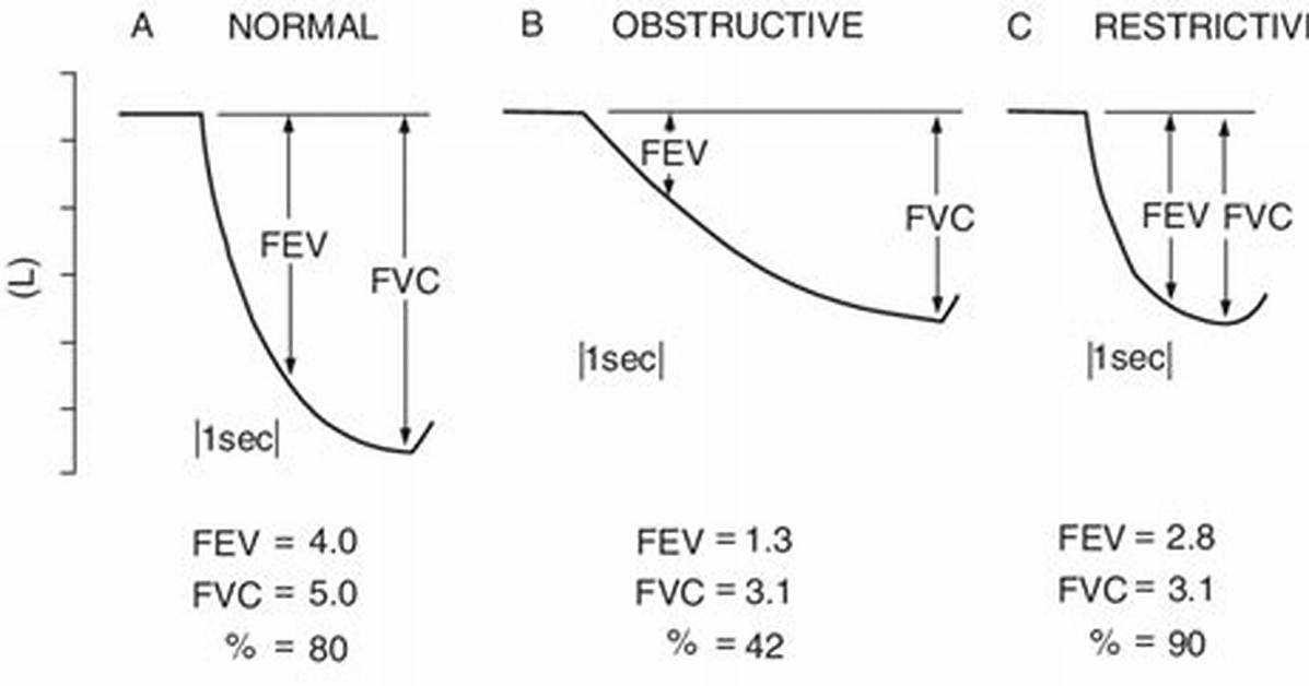 Is Obstructive Ventilatory Defect?